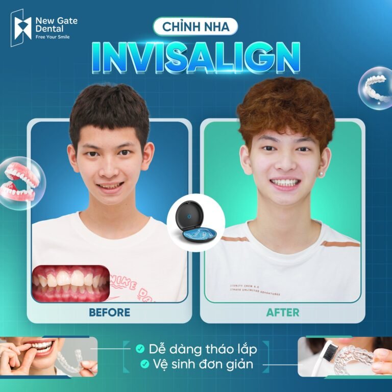 Niềng răng trong suốt cho trẻ em